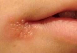 Herpes Virus