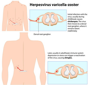 Herpesvirus Varicella