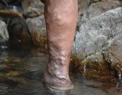 Varicose Veins Cropped