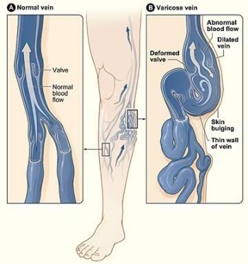 Varicose Veins Form